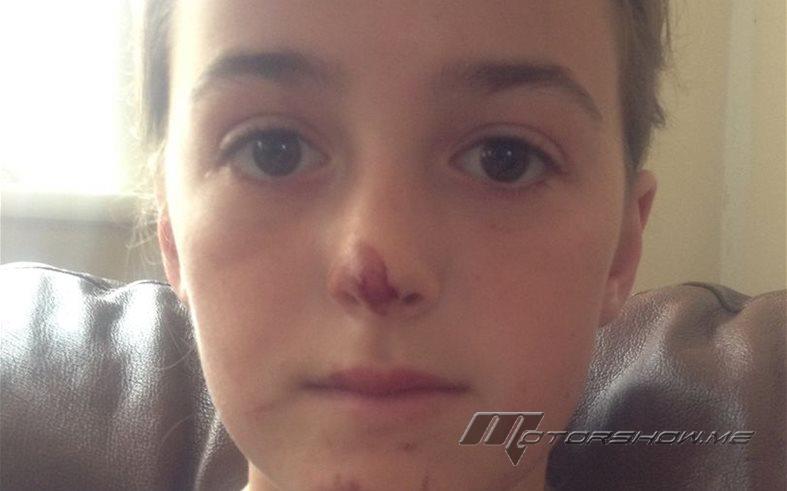 أمّ تنتقد الشرطة بقسوة بعد تسببها بجروج في وجه ابنتها! 